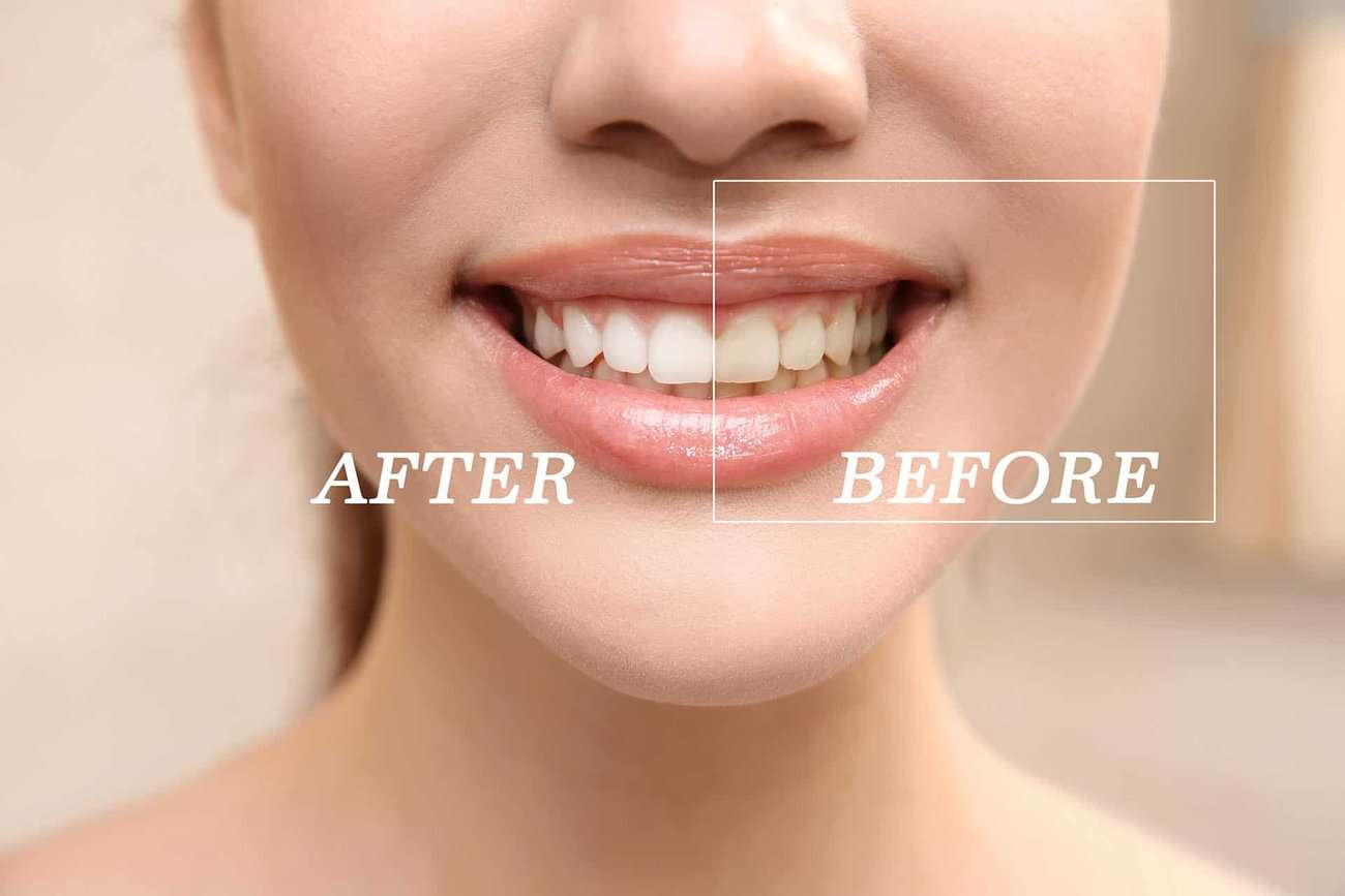 How Can You Maintain a Consistent Smile Shade with Crowns Wakefield?