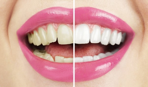 What Makes Ultima White Teeth Whitening Different Wakefield