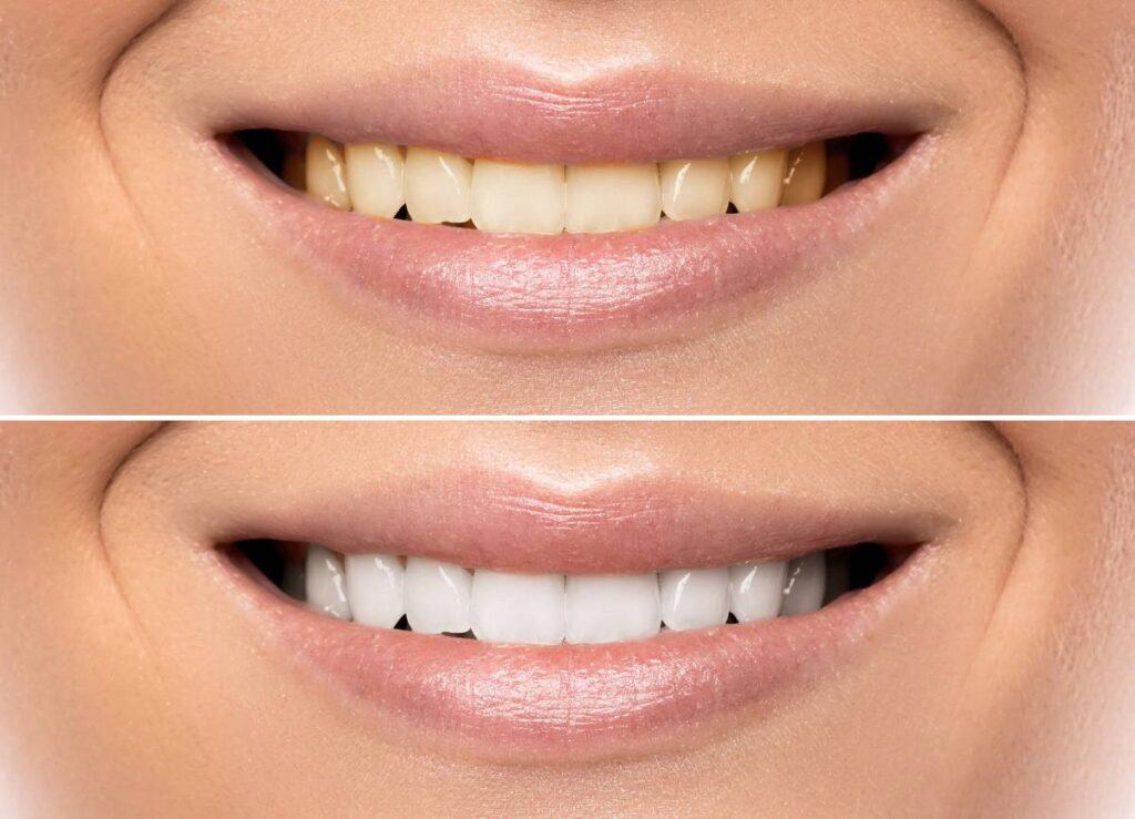 How Does Gum Disease Progress if Left Untreated Wakefield?