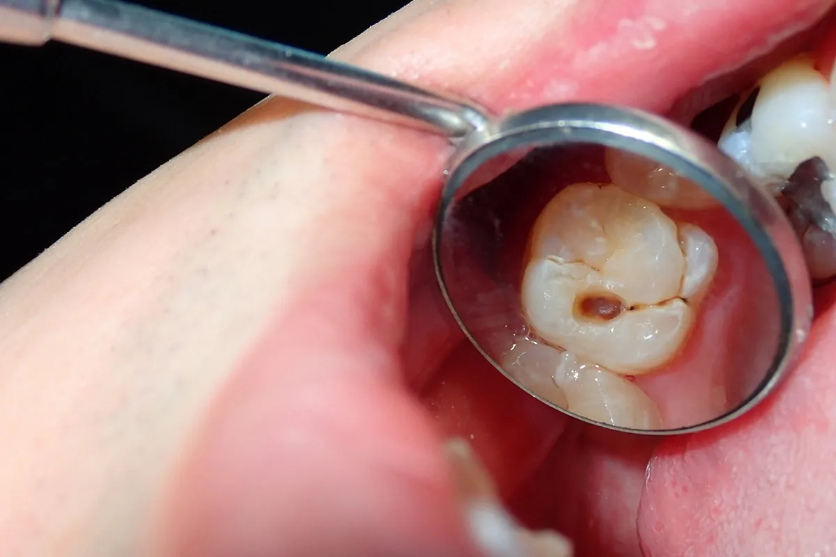 Why Do Teeth Crack? Common Causes to Know Wakefield