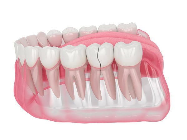 How Can You Manage Pain and Discomfort After a Root Canal Wakefield?
