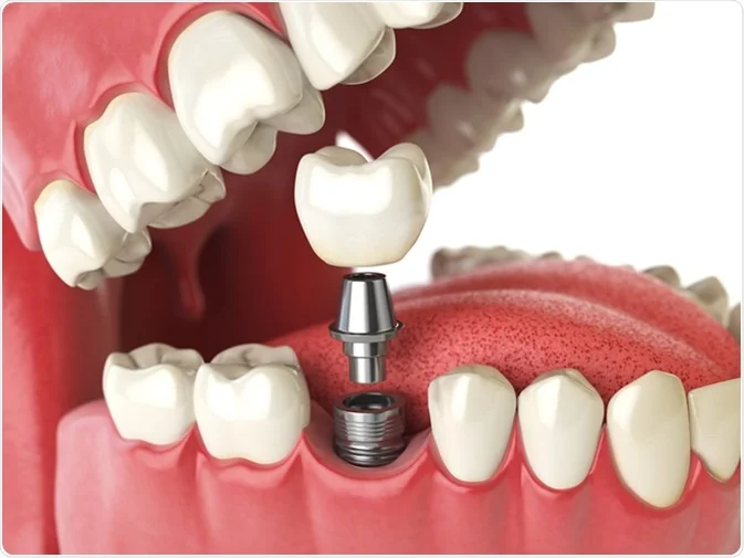 How Do I Decide Which Tooth Replacement Is Right for Me Wakefield?