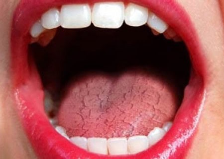 Common Causes of Dry Mouth (Xerostomia) Wakefield
