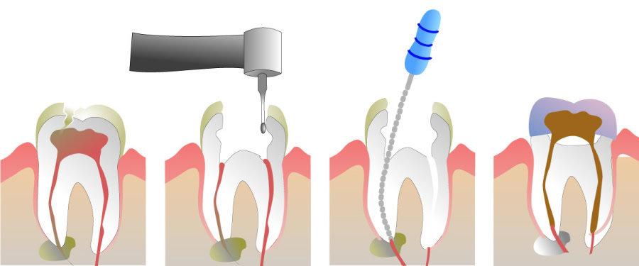 How Do You Properly Care for Your Teeth After a Root Canal Wakefield