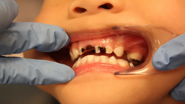 Which Foods and Drinks Cause the Most Damage to Young Smiles Wakefield?