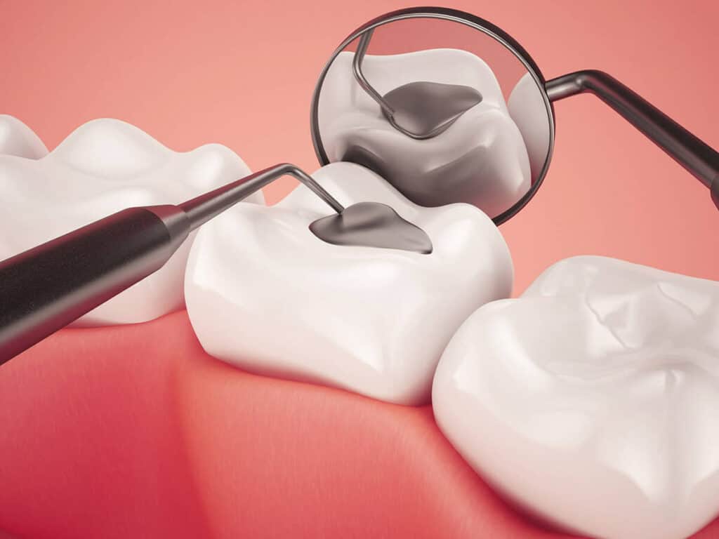 How Can You Prevent Tooth Decay Effectively Wakefield