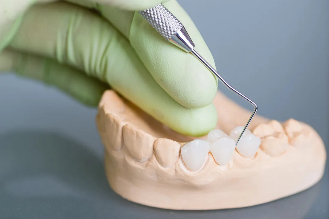 What Are the Different Types of Dental Crowns Available Wakefield?