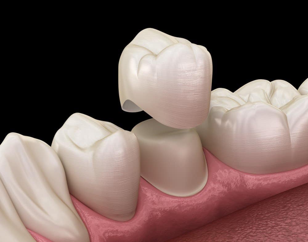 What Daily Habits Help Protect Your Dental Crowns Wakefield?